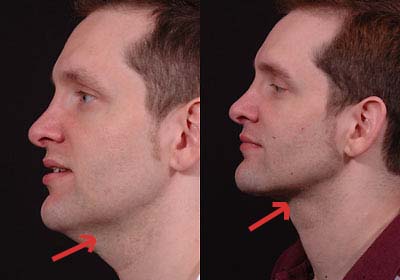 weight loss double chin